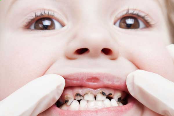 Pediatric Dental Treatments