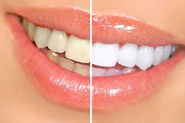 Scaling & Polishing / Teeth Cleaning