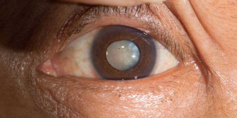 Cataract Treatment Ichalkaranji