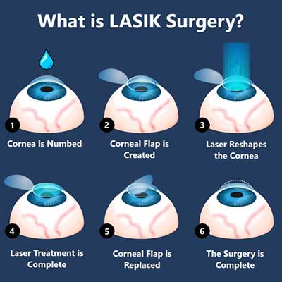 Best Lasik Surgeon